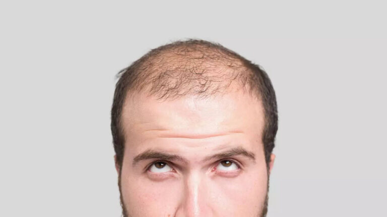 Is there a link between baldness and heart health?